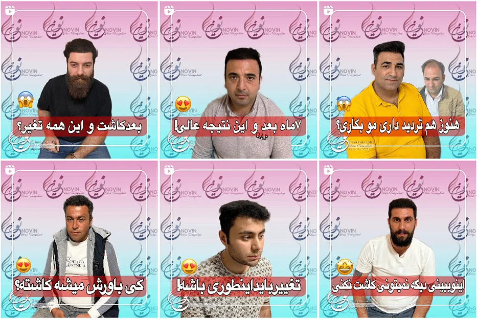 نمونه کار کاشت مو در تبریز توسط کلینیک نوین