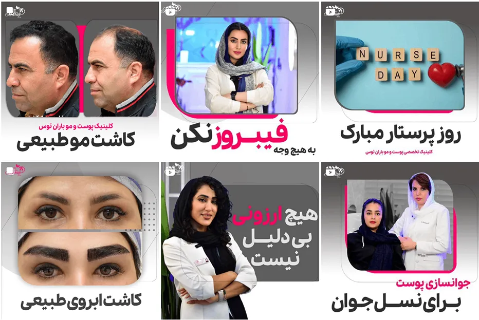 کاشت مو مشهد اقساطی توسط کلینیک زیبایی توس کاملا قابل رزرو است