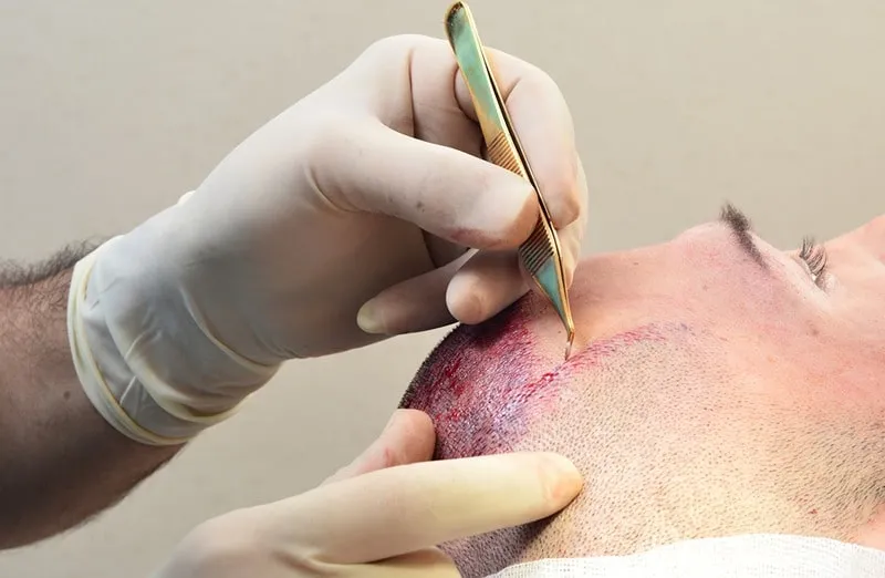 با رعایت موارد متعددی میتوان درد کاشت مو را به راحتی کاهش داد