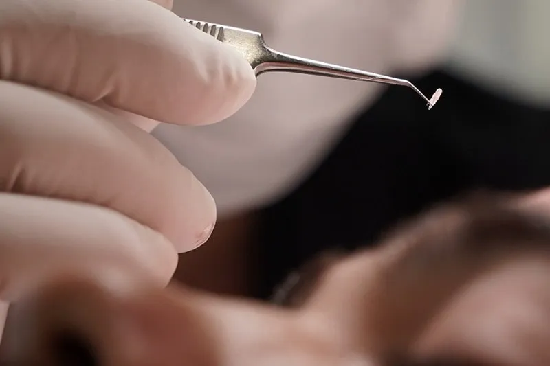 در کاشت مو به روش SUTدیگر شاهد برداشت دستی پیوندهای مو نیستیم.