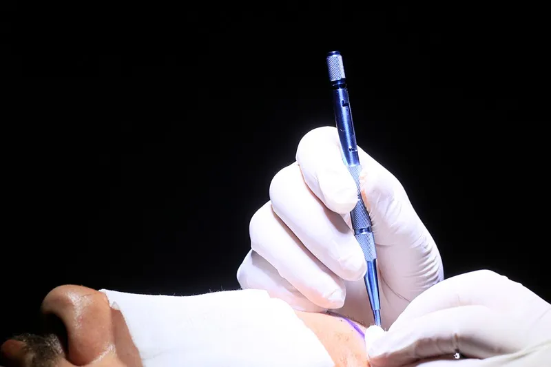 کاشت مو به روش میکرگرافت یکی از بهترین روش کاشت مو است