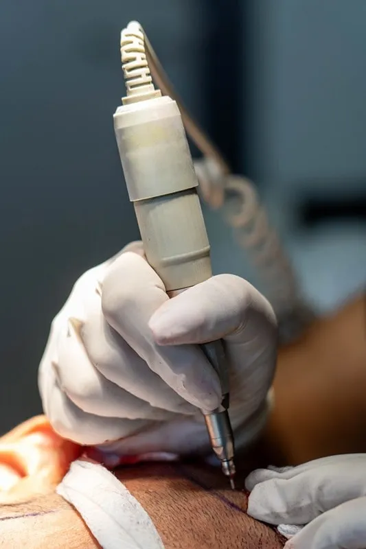 کاشت مو به روش SUT مزایای بسیاری را نصیب ما میکند