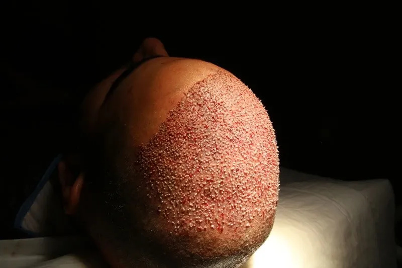 اف آی تی مو چیست؟ از روش های بسیا مطلوب کاشت مو با کمترین میزان عوارض است