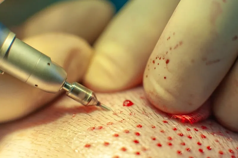 کاشت مو sut از جمله روش های نیمه اتوماتیک در این فرایند است