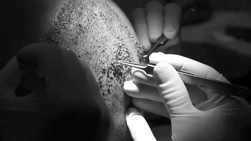 کاشت مو از ریش فواید بیشماری را برای ما دارد.