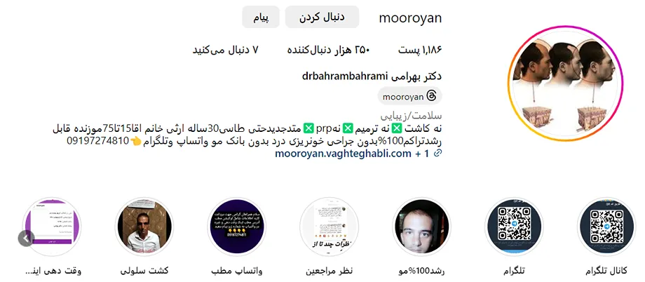 قیمت کاشت مو در تهران و در کلینیک موریان کاملا مناسب است