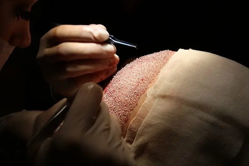 کاشت مو به روش fit یکی از روش های کاشت مو از ریش است