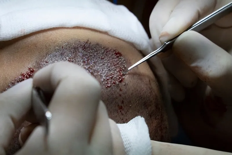 اف آی تی مو یکی از بهترین روش های کاشت مو در کشورمان است.