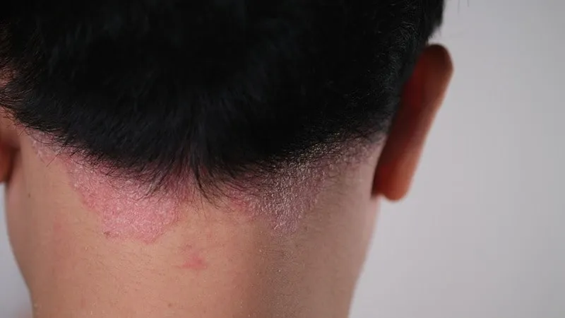 ایجاد عفونت یکی از حالت های حاد خارش سر بعد از کاشت مو است