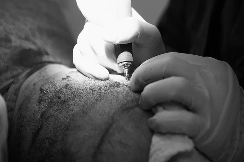 کاشت مو به روش sut یکی از بهترین متدها . تکنیک های کاشت مو است