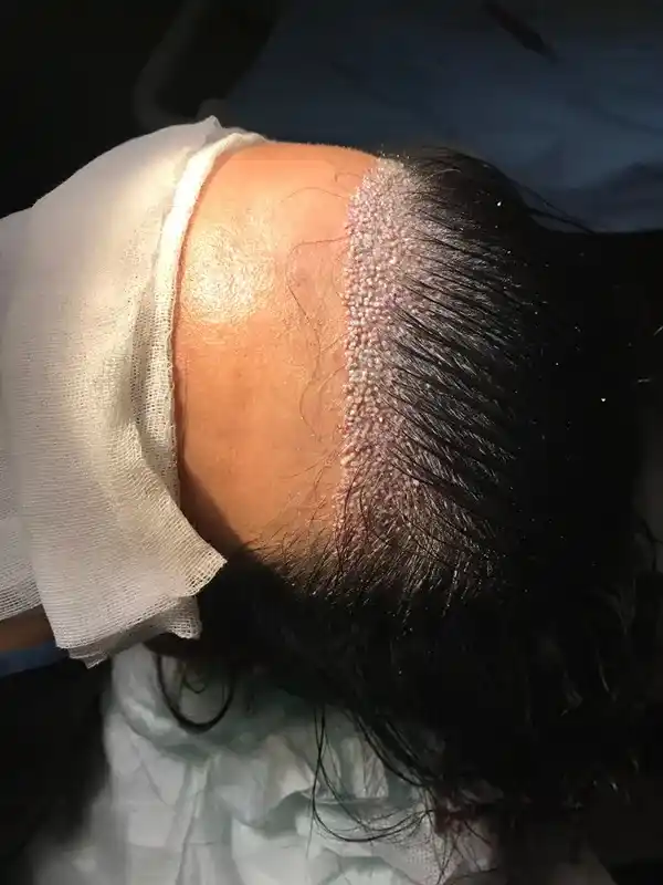 انجام کاشت مو در بانوان، جراحی بسیار ایمن و مطمئن است.