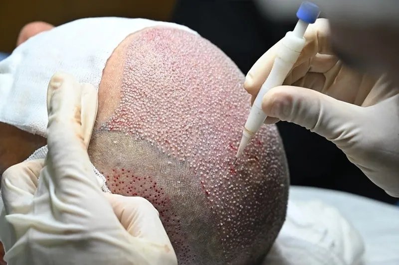 در بیاری از اوقات، تورم صورت بعد از کاشت مو کاملا طبیعی است.