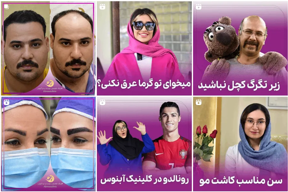 کاشت مو اقساطی در مشهد در کلینیک آبنوس کاملا قابل انجام است