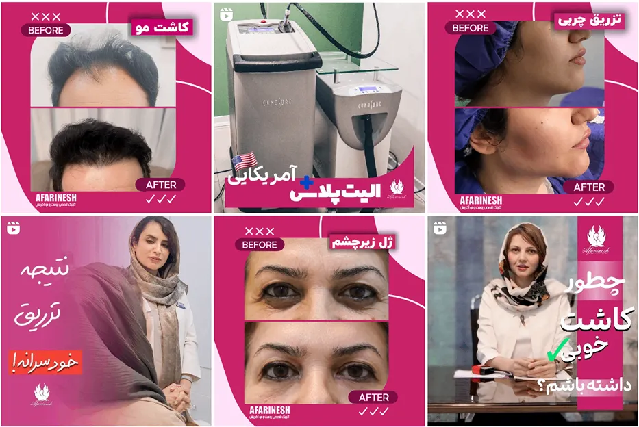 کاشت مو مشهد اقساطی در کلینیک آفرینش قابل انجام است