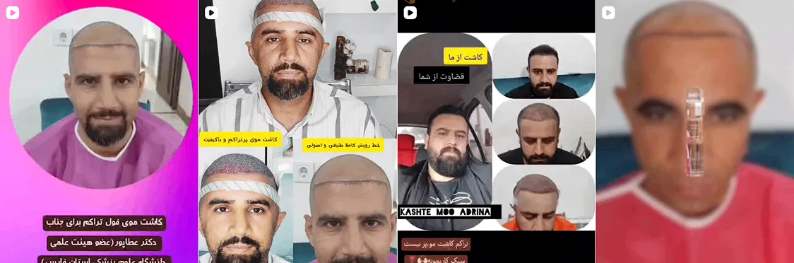 نمونه کار موفق کاشت مو بوشهر را مشاهده میفرمایید.