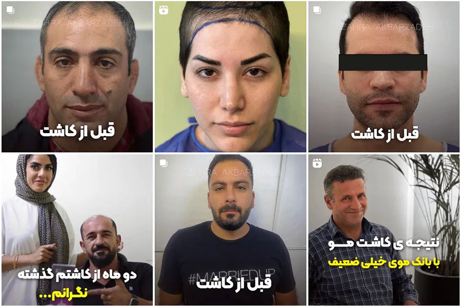 تصویر یکی از بهترین دکتر کاشت مو در تهران را مشاهده میفرمایید.
