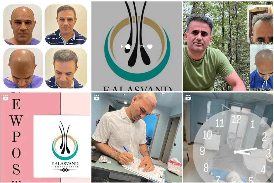 کاشت مو در اهواز توسط دکتر علاسوند کاملا قابل انجام است