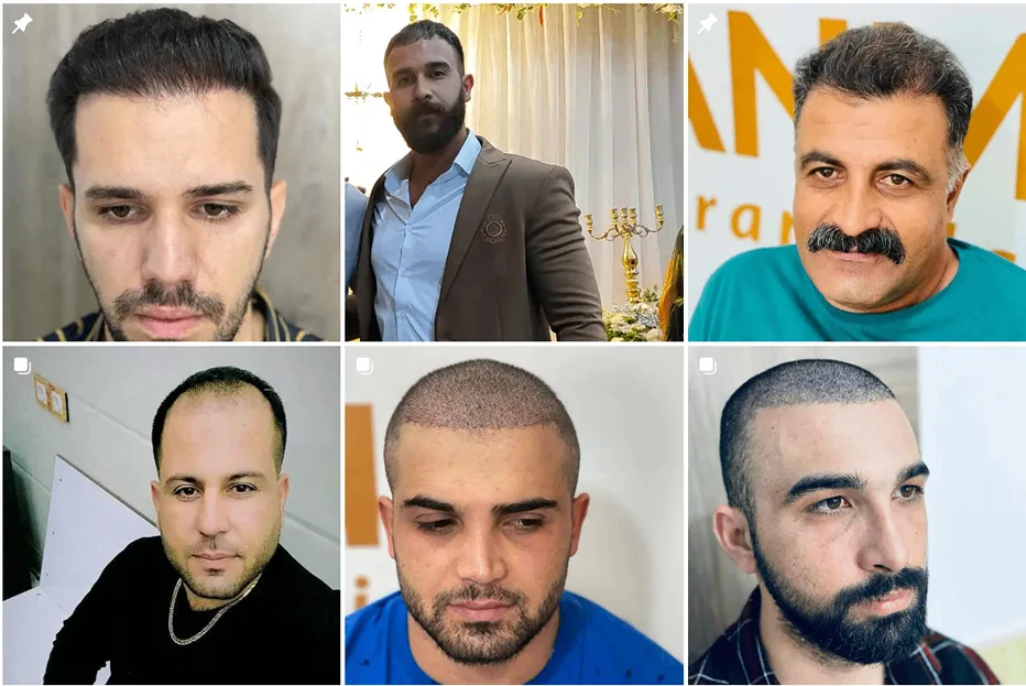 نمونه کار خانم علی نژاد از بهرتین متخصصین کاشت مو در یاسوج را مشاهده میفرمایید.