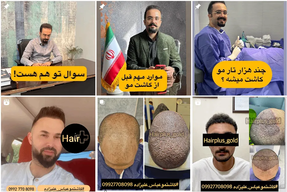 تصویر یکی از بهترین دکتر کاشت مو اقساطی در مشهد را مشاهده میفرمایید.