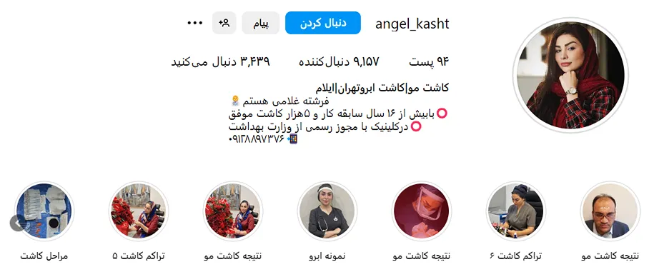 کاشت مو در ایلام توسط فرشته غلامی کاملا قابل انجام است