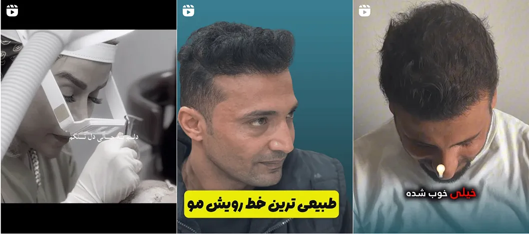 نمونه کار بهترین دکتر کاشت مو در اهواز را مشاهده میفرمایید
