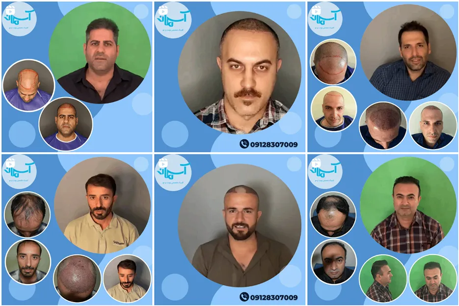 کاشت مو تهران در کلینیک تخصصی آسمان کاملا قابل انجام است