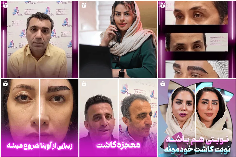 تصویر یکی از بهترین کلینیک کاشت مو در تهران را مشاهده میفرمایید.