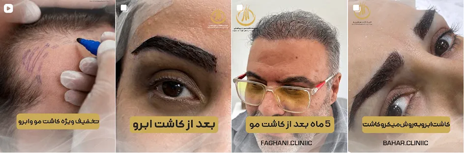 کاشت مو در گرگان در کلینیک زیبایی بهار کاملا قابل انجام است
