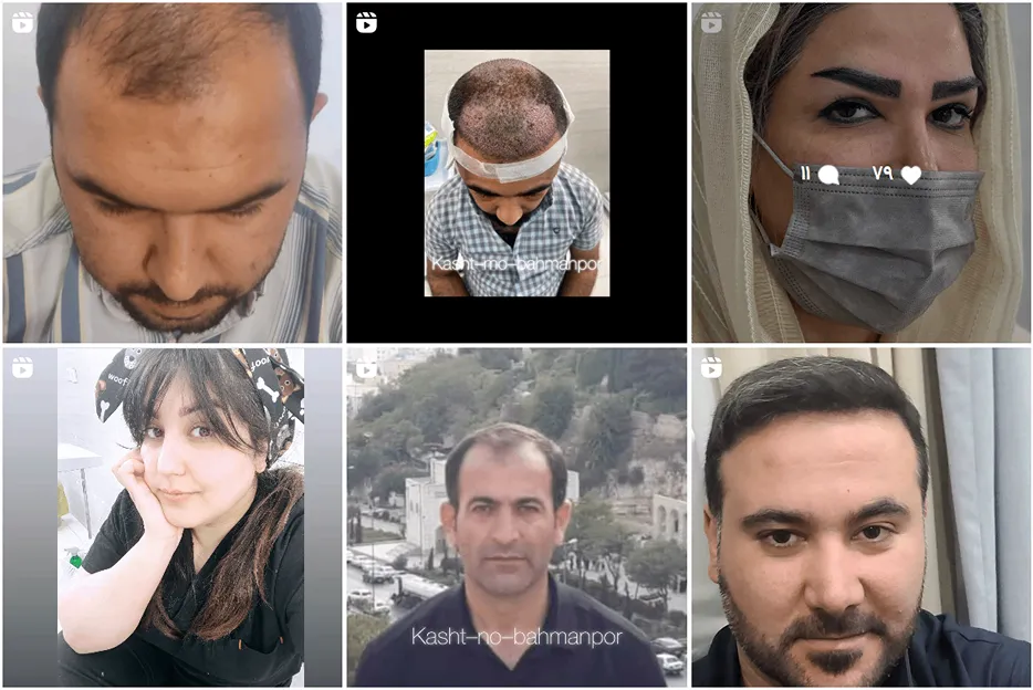 تصویر یکی از بهترین مرکز کاشت مو در اهواز را مشاهده میفرمایید.