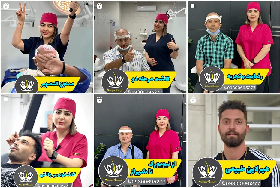 کاشت مو شیراز توسط نیلوفر بلافی کاملا قابل انجام است