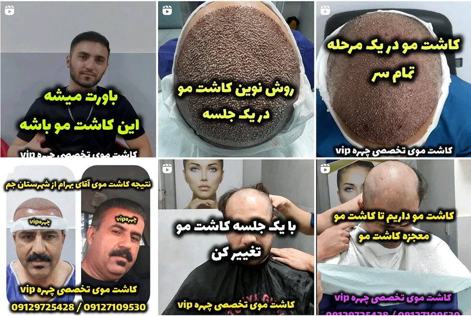 کاشت مو در تهرن توسط دکتر دالوند کاملا قابل انجام است