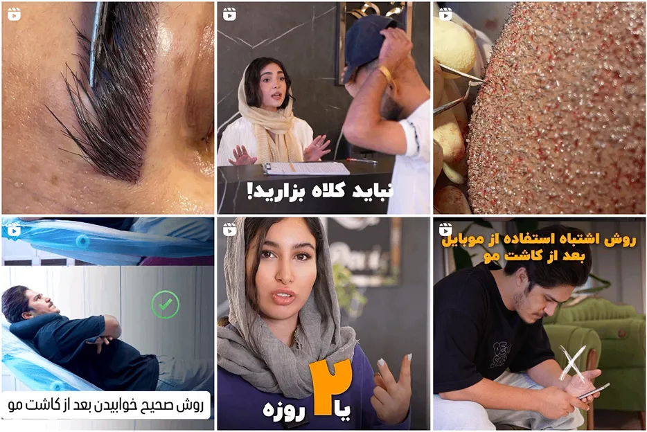 کاشت مو اقساطی مشهد در کلینیک دنیز قابل انجام است