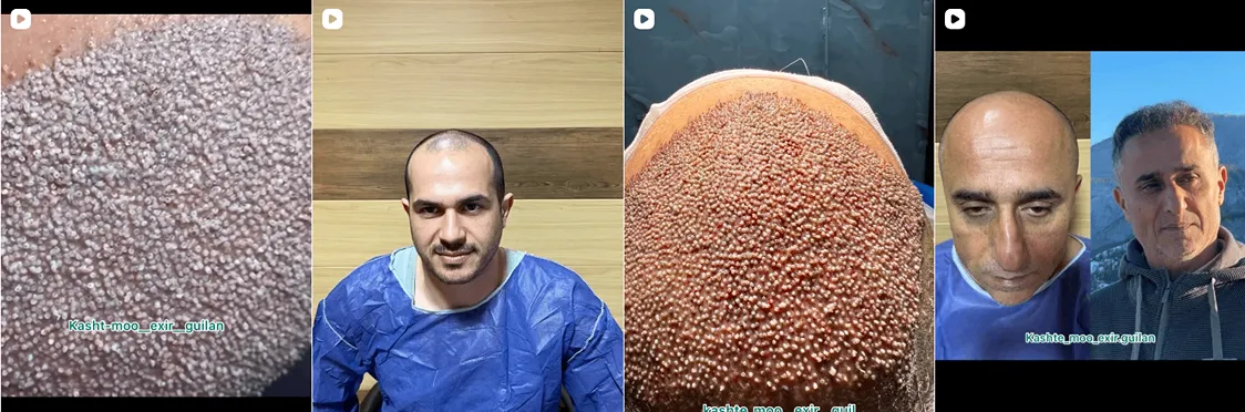 نمونه کار ییک از بهترین دکتر کاشت مو در رشت را مشاهده میفرمایید
