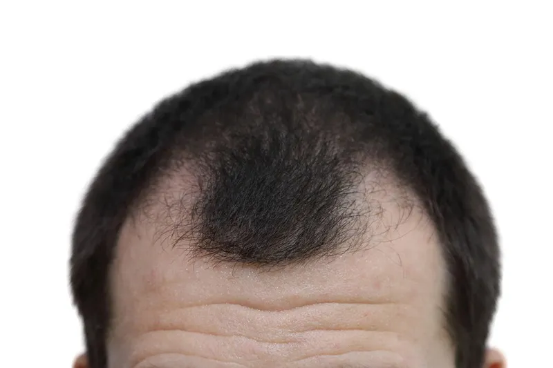 شوک ریزش مو بعد از کاشت، یکی از مراحل کاملا طبیعی و ارگانیگ رشد مو انسان است