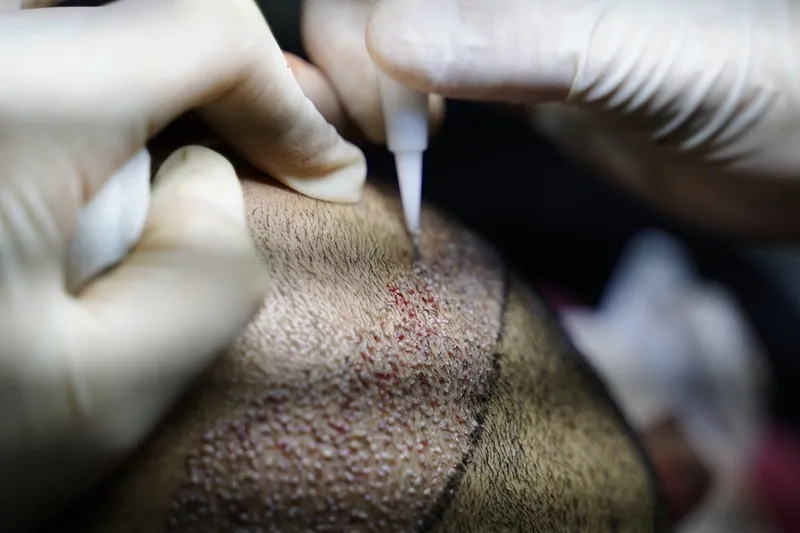 یکی از روش های کاشت مو بابانک مو ضعیف ترکیب روش های FIT و FUT است