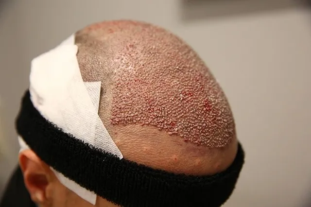 با مراقبت بعد از کاشت مو به راحتی میتوان دلمهها را از بین برد.