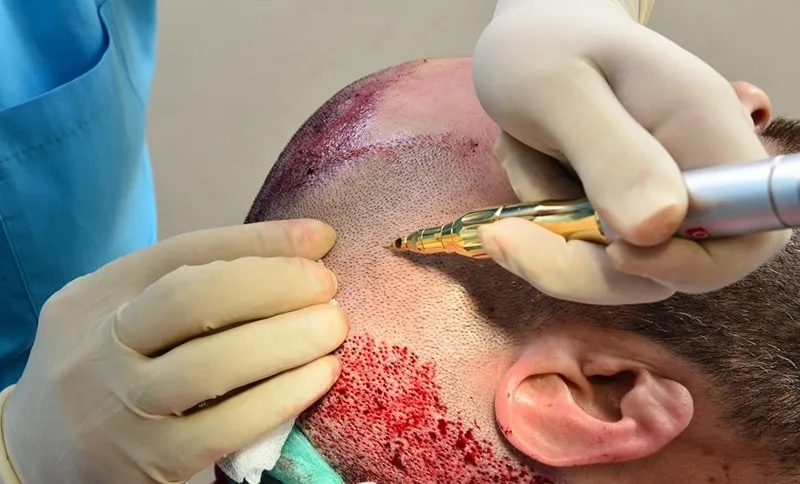 از جمله دلایل ورم صورت بعد از کاشت مو، خونریزیهای مجمدود بعد از کاشت است.