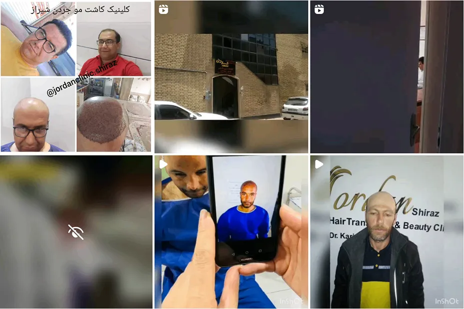 کلینیک جردن یکی از بهترین کلینیک کاشت مو در شیراز است