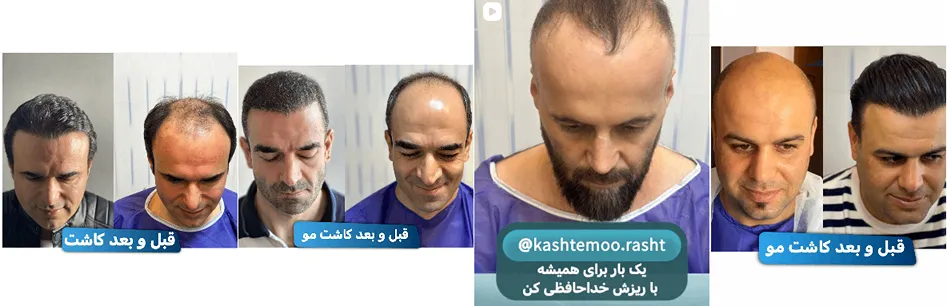 کاشت مو در رشت در کلینیک تخصصی کاشت مو رشت کاملا قابل انجام است
