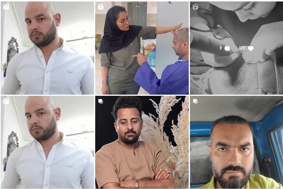 کاشت مو مشهد اقساطی توسط سرکار خانم خاکشوری کاملا قابل انجام است