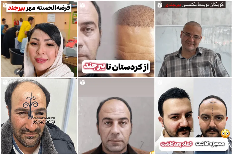 زهرا خسروی از بهرتین دکتر کاشت مو بیرجند است