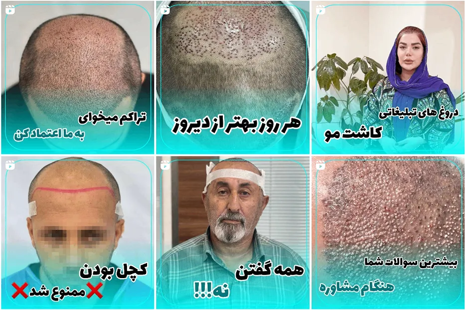 کاشت مو اهواز در نزد خانم خسروی کاملا قابل انجام است