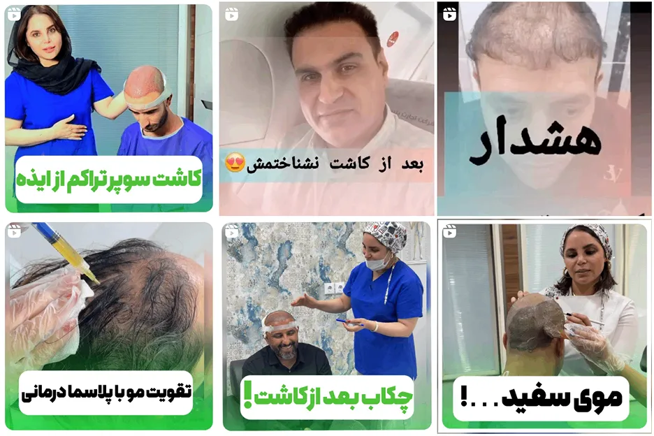 کاشت مو در اهواز توسط شیوا کیانی کاملا قابل انجام است