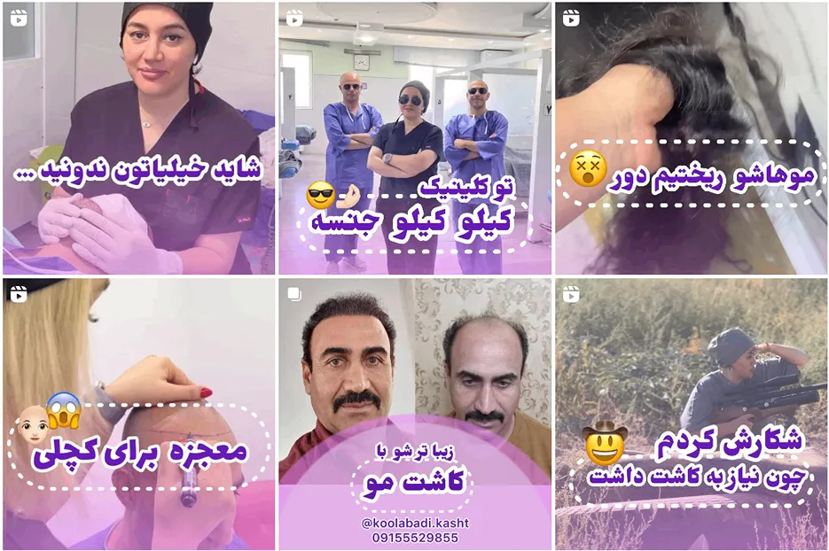 کاشت مو اقساطی مشهد توسط خانم کول ابادی کمالا قابل انجام است