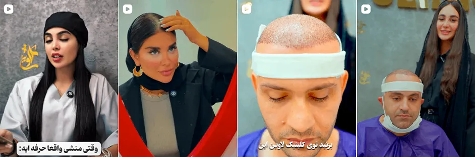 کاشت مو رشت در کلینیک زیبایی لاوین کاملا قابل انجام است