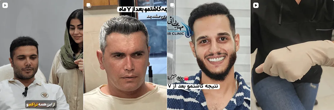 نمونه کار یکی از بهترین دکتر کاشت مو در رشت را مشاهده میفرمایید.