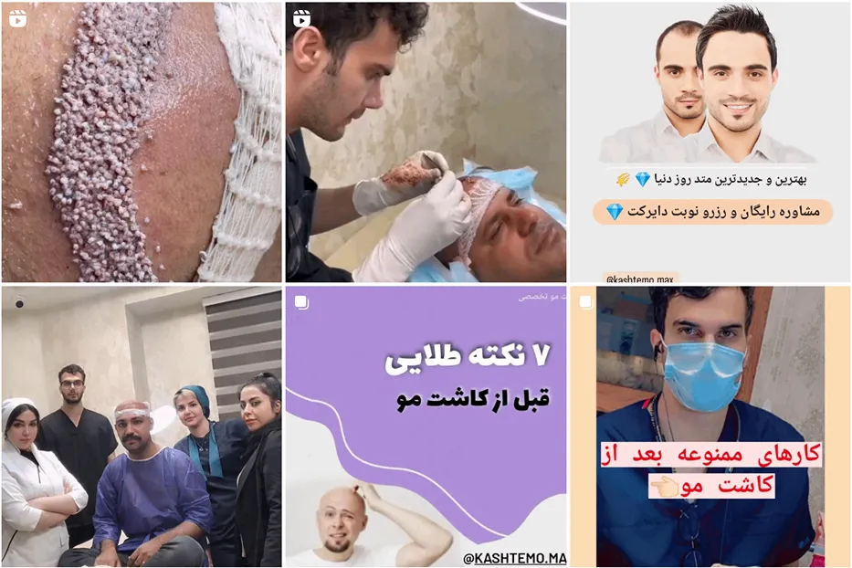 تصویر یکی از بهترین کلینیک کاشت مو در یاسوج را مشاهده میفرمایید.