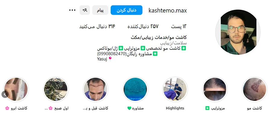 کاشت مو در یاسوج در کلینیک مکث کاملا قابل انجام است