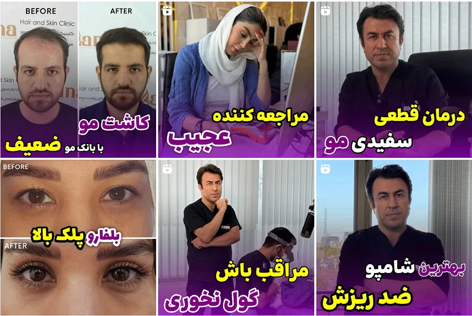 کلینیک مانا یکی از بهترین کلینیک کاشت مو اقساطی در مشهد است