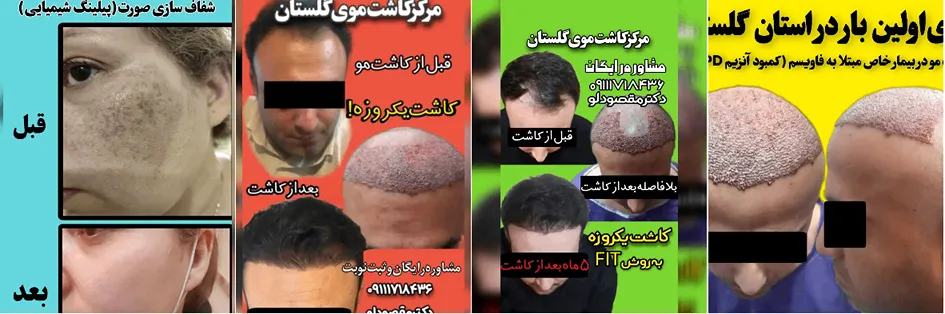 کاشت مو گرگان توسط دکتر علی مقصودلو کاملا قال انجام است